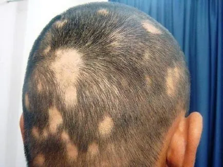 Androgén alopecia a férfiak és a hajhullást okoz