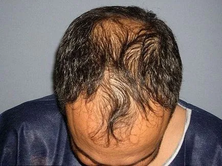 Androgén alopecia a férfiak és a hajhullást okoz