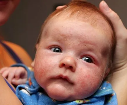 Allergia csecsemőknél - egy nehéz teszt az első életévben