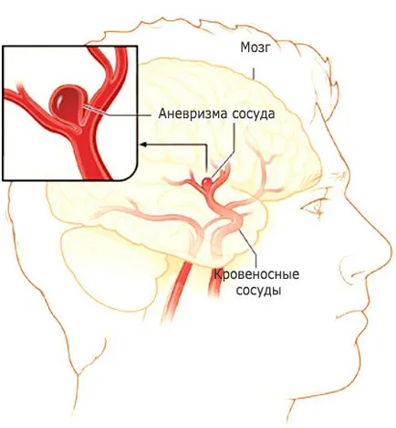 Anevrismelor si accident vascular cerebral - Tratamentul Inimii