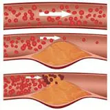 cauzează boli cardiovasculare aterosclerotice, simptome, diagnostic și tratament