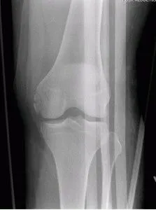 Osteoarthritis a térdízület 1 fok tünetek és a kezelés