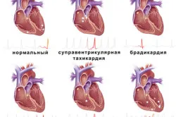 aritmie cardiaca cauze, simptome și tratament