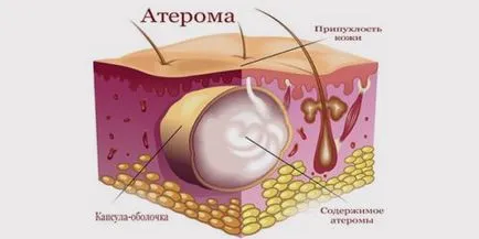 Atheroma okok, tünetek és a kezelés