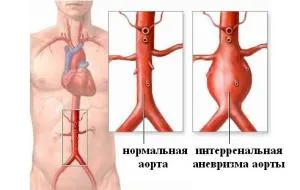 Бифуркация на аортата и нейните патологични изменения