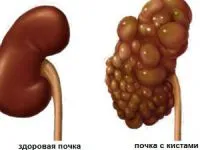 Ormond-kór (retroperitonealis fibrosis), mi az, kezelés, diéta