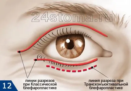 Szemhéjplasztika a szem alatti táskák, hogy megszabaduljon, fotók előtt és után