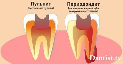 Biológiai kezelés A fogbélgyulladás, bizonyság állapotok