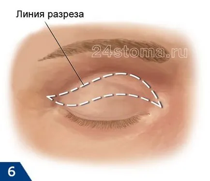 saci Blefaroplastia sub ochi pentru a scăpa, fotografii înainte și după