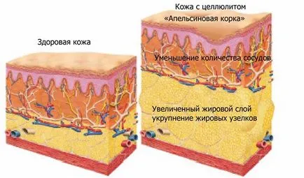 Целулитът след раждането на стомаха й, краката минават, ако той е да се премахнат симптомите, да се отървете