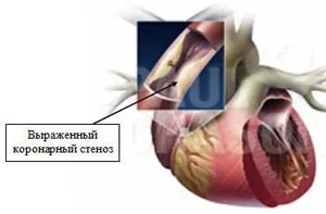 Mi angina pectoris