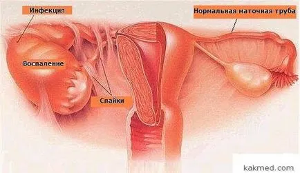 Mi oophoritis tünetek és kezelés a petefészek-gyulladás