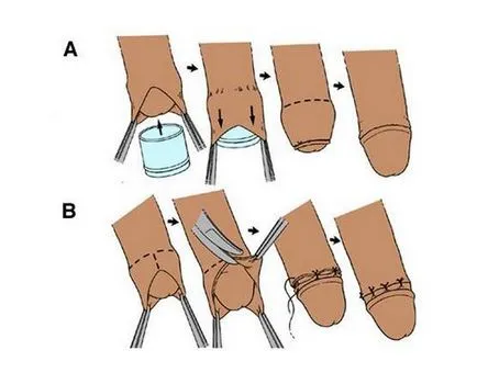 Какво е обрязване на момчетата и това, което тя трябва да изглежда като след операцията, възрастта, на която
