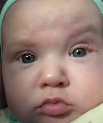 Dacryocystitis szem és kötőhártya-gyulladás újszülött fotók, tünetei, kezelése és dacryocystitis