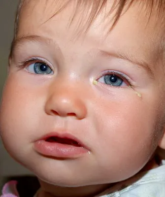 Dacryocystitis szem és kötőhártya-gyulladás újszülött fotók, tünetei, kezelése és dacryocystitis