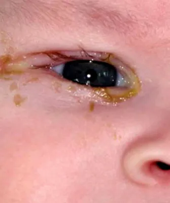 Dacryocystitis очите и конюнктивит при новороденото бебе снимки, симптоми, лечение и dacryocystitis