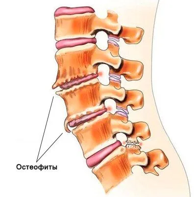 Деформирайки спондилоза на симптомите на гръбначния стълб, причини и лечение