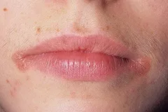 Eczeme pe buze ce instrumente va ajuta la vindecarea rapidă a bolii