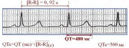 EKG (EKG) -simptomy, aritmia tünetek és a kezelés Fehéroroszország