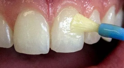 Ерозията на зъбния емайл симптоми, причини, лечение, профилактика