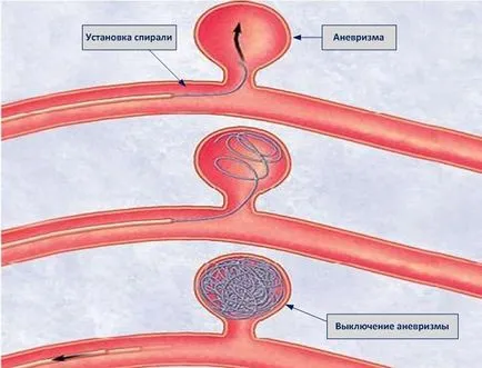 Ендоваскуларна емболизация на мозъчна аневризма - мозъчно-съдови емболизация на аневризма