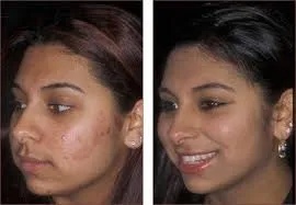 Face Glycolic hámlás