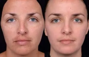 Face Glycolic hámlás