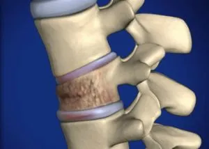 spinal hemangiom - ceea ce este, simptome și tratament