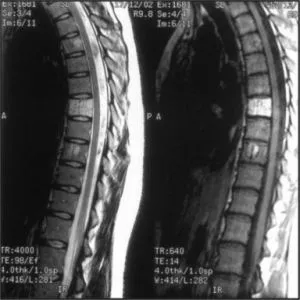 spinal hemangiom - ceea ce este, simptome și tratament