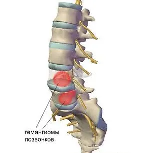 Hemangiom tratamentului coloanei vertebrale cervicale si toracice, cauze, simptome