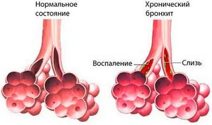 Reverzibilis bronchitis fajok és különösen kezelési módszerek