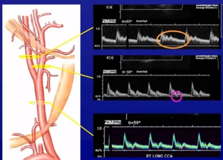 Дуплекс сканиране на brachiocephalic артерии Какво има, кога и защо се назначават - Здраве
