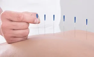 Acupunctura pentru tratarea insomniei - funcționari centru medical