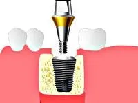 Implantációs (folyamat leírás)