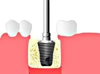 Implantarea (descriere proces)