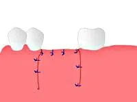 Implantarea (descriere proces)