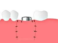 Implantarea (descriere proces)