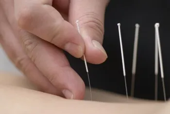 Akupunktúra és az akupresszúra kínai orvoslás