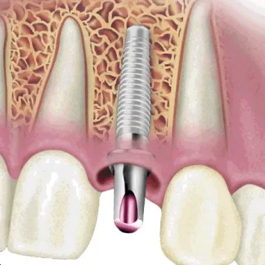 Implanturile dentare la cheie