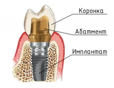 Implanturile dentare la cheie