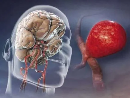 Accident vascular cerebral si anevrism este diferența