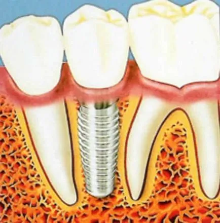 Implantációs (folyamat leírás)