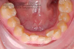 Corectarea ocluziei distale pe aparat dentar Damon