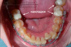 Corectarea ocluziei distale pe aparat dentar Damon