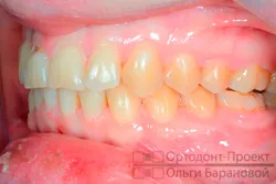 Corectarea ocluziei distale pe aparat dentar Damon