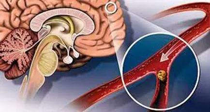 accident vascular cerebral ischemic, la o varsta frageda cauze, simptome, clasificare, complicații