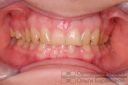 Corectarea ocluziei distale pe aparat dentar Damon