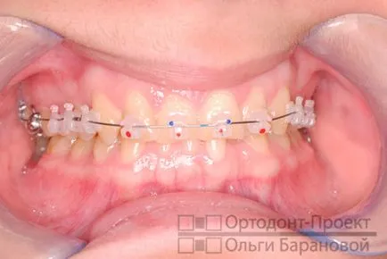 Corectarea ocluziei distale pe aparat dentar Damon