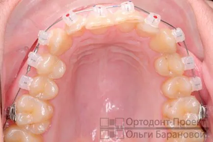 Corectarea ocluziei distale pe aparat dentar Damon