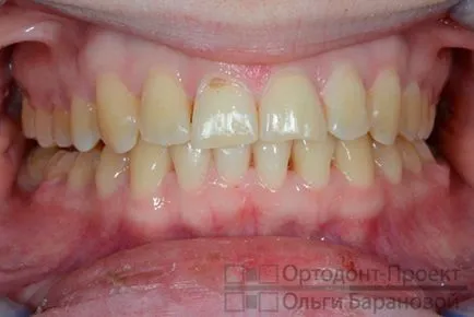 Corectarea ocluziei distale pe aparat dentar Damon